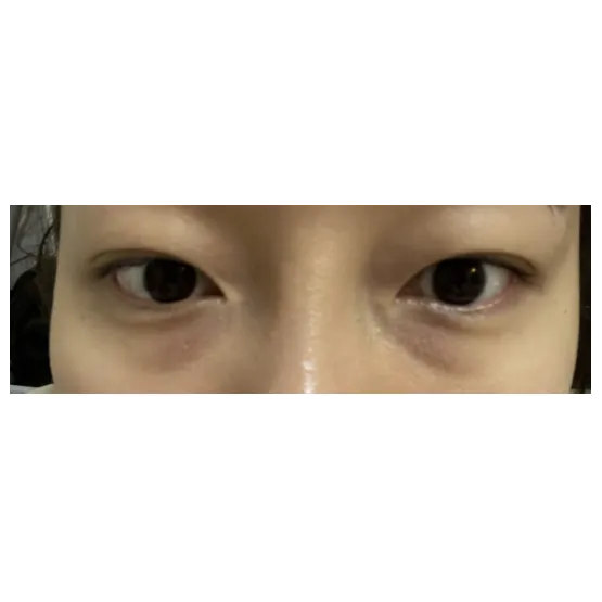 Lower Eyelid Fat Repositioning 1