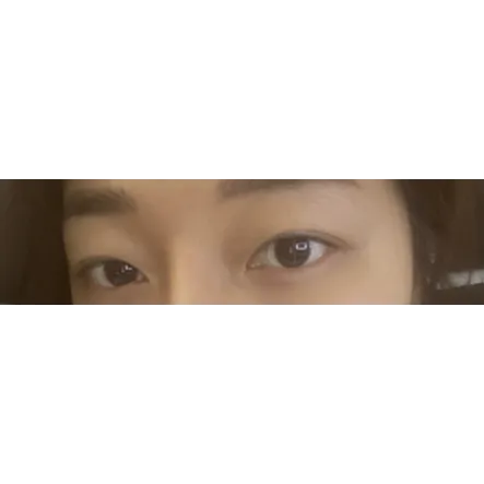 Lower Eyelid Fat Repositioning 2