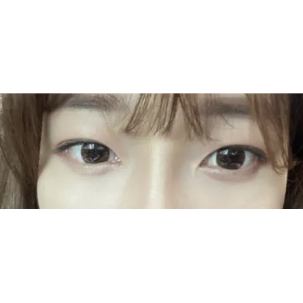 Lower Eyelid Fat Repositioning — Afternoon Plastic Surgery 3