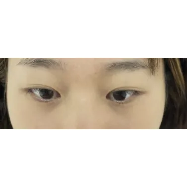 Non-incisional double eyelid surgery — Afternoon Plastic Surgery 1