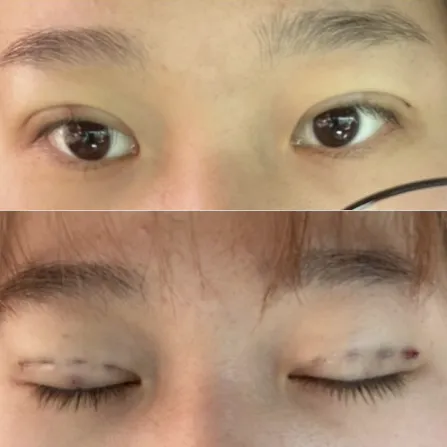 Non-incisional double eyelid surgery — Afternoon Plastic Surgery 2