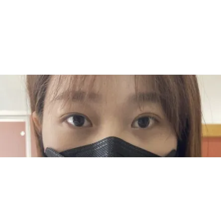Non-incisional double eyelid surgery — Afternoon Plastic Surgery 3