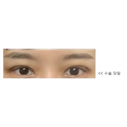 Incisional Double Eyelid Surgery, Ptosis Correction 2