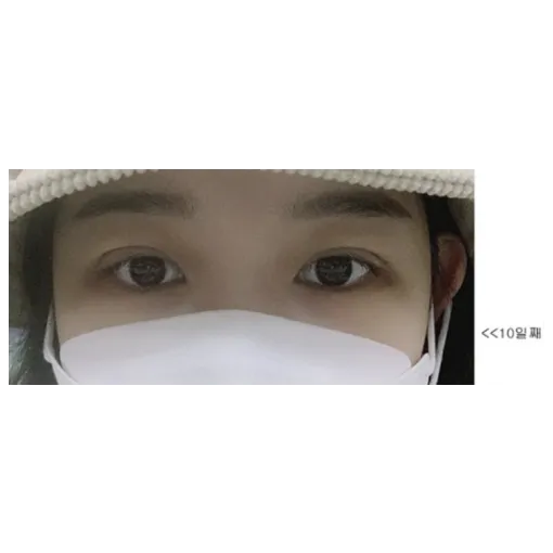 Incisional Double Eyelid Surgery, Ptosis Correction — Afternoon Plastic Surgery 4
