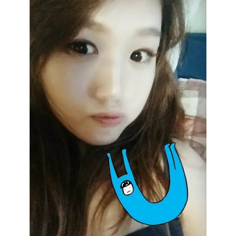 Incisional Double Eyelid Surgery 1