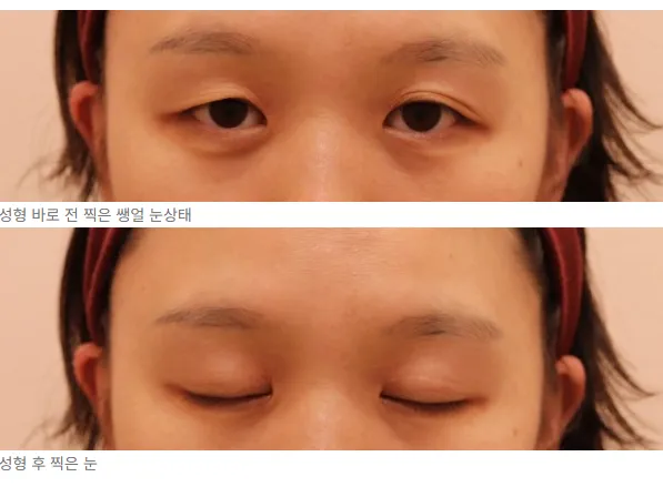 Incisional Double Eyelid Surgery — Afternoon Plastic Surgery 3