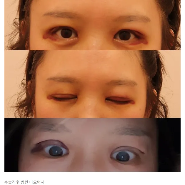 Incisional Double Eyelid Surgery — Afternoon Plastic Surgery 4