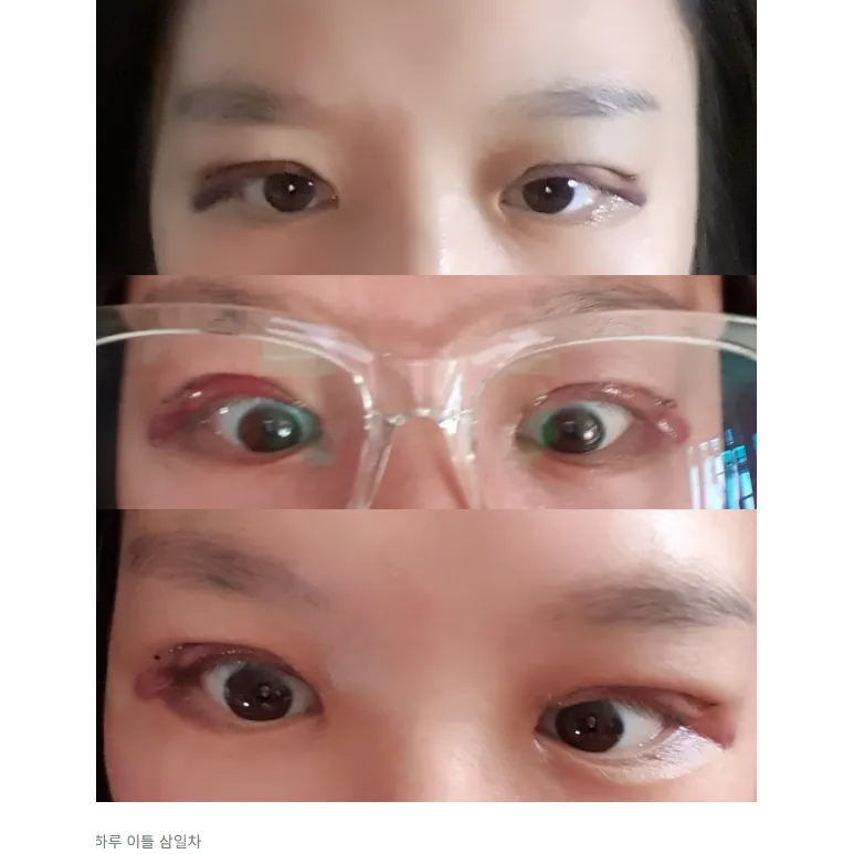 Incisional Double Eyelid Surgery — Afternoon Plastic Surgery 5