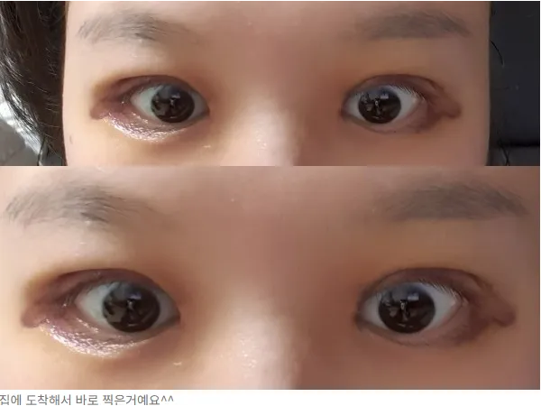 Incisional Double Eyelid Surgery — Afternoon Plastic Surgery 6