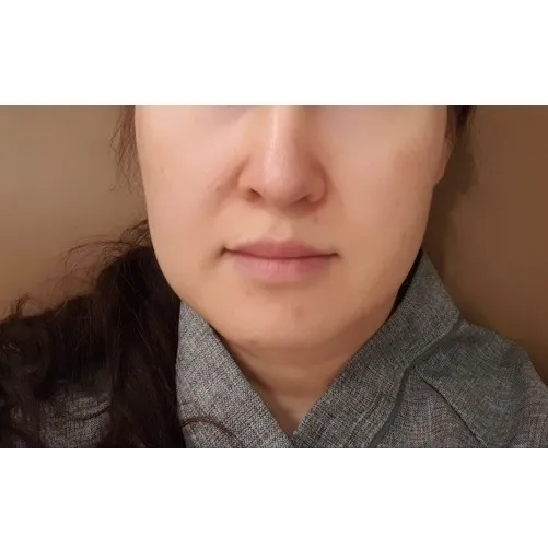 ミニリフト — Afternoon Plastic Surgery 1