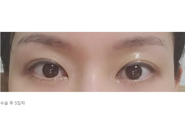 Non-incisional double eyelid surgery — Afternoon Plastic Surgery 2