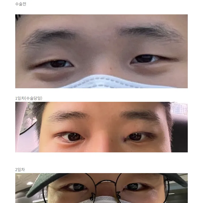 Incisional Double Eyelid Surgery, Epicanthoplasty 1