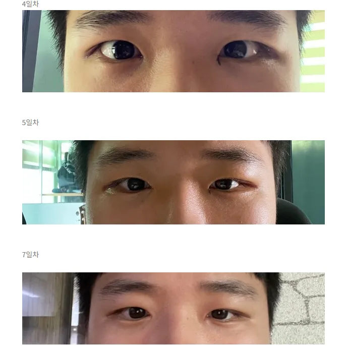 Incisional Double Eyelid Surgery, Epicanthoplasty 2