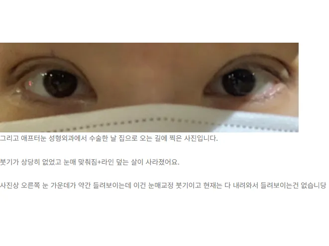 Incisional Double Eyelid Surgery — Afternoon Plastic Surgery 2