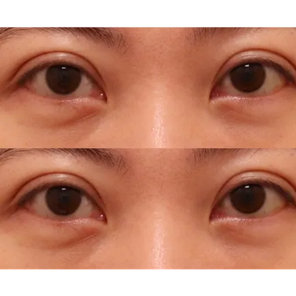 Lower Eyelid Fat Repositioning 1