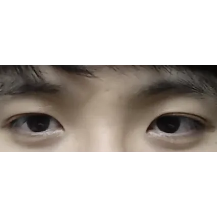 Lateral canthoplasty 1