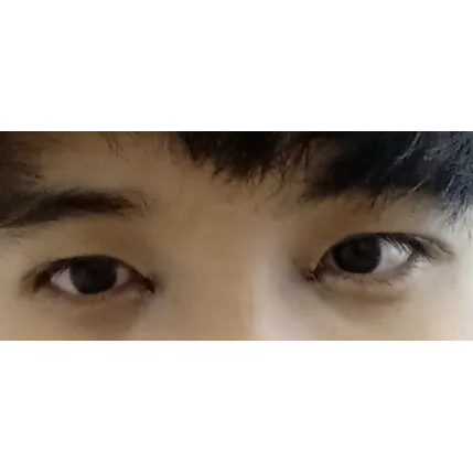 Lateral canthoplasty 2