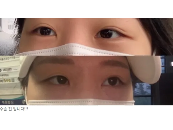 Revision ptosis correction, Epicanthoplasty 1