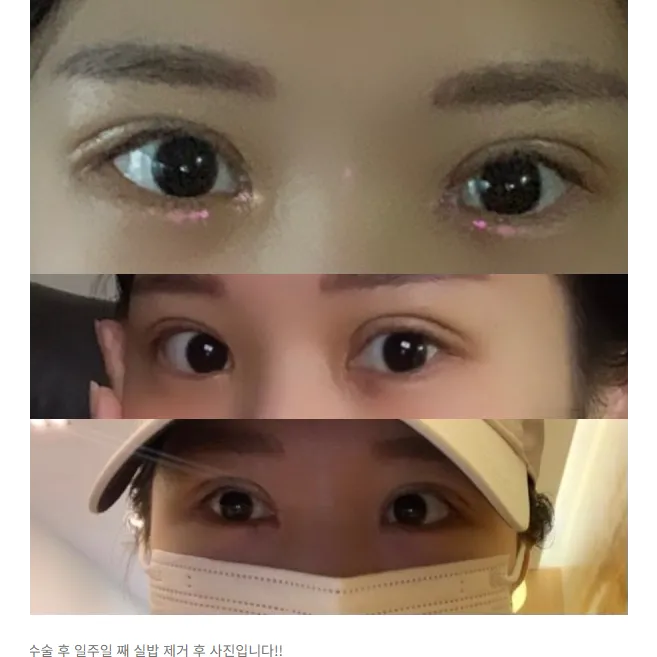 Revision ptosis correction, Epicanthoplasty 2