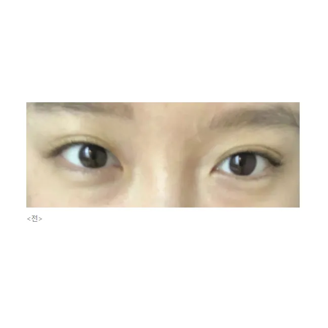 Non-incisional double eyelid surgery, Lower Eyelid Fat Repositioning 1