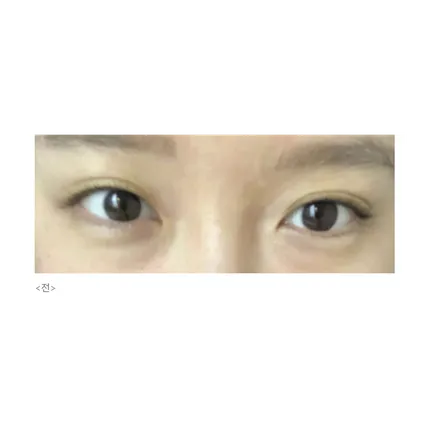 Non-incisional double eyelid surgery 1