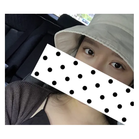 Non-incisional double eyelid surgery, Lower Eyelid Fat Repositioning — Afternoon Plastic Surgery 2