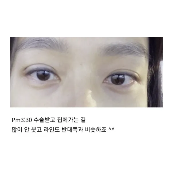 Non-incisional double eyelid surgery — Afternoon Plastic Surgery 2