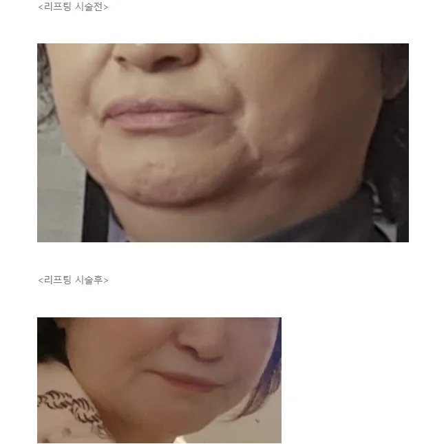 Lower Face Lift, Mini Facelift 2