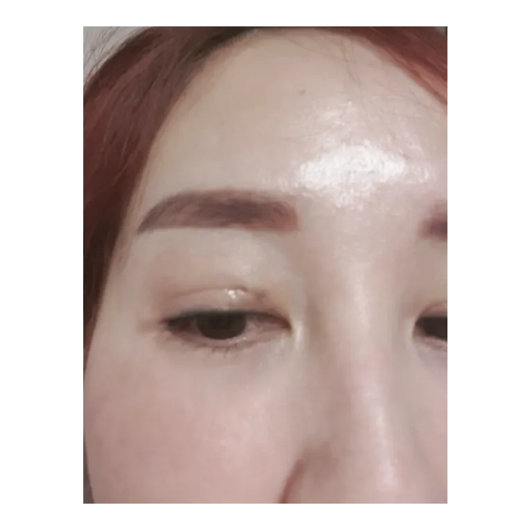 Non-incisional double eyelid surgery — Afternoon Plastic Surgery 1
