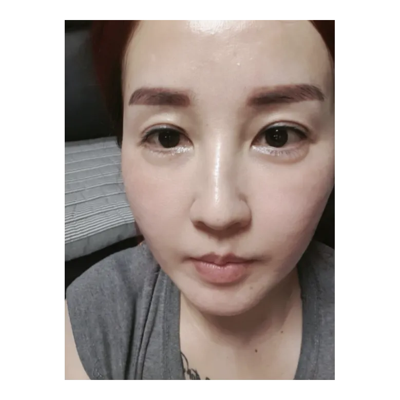 Non-incisional double eyelid surgery — Afternoon Plastic Surgery 2