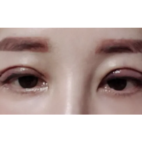 Incisional Double Eyelid Surgery, Revision ptosis correction — Afternoon Plastic Surgery 2