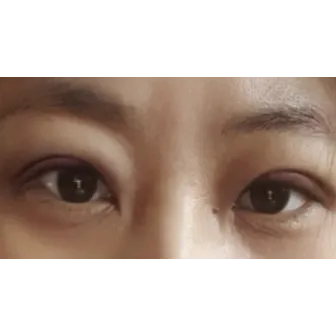 Revision ptosis correction — Afternoon Plastic Surgery 2