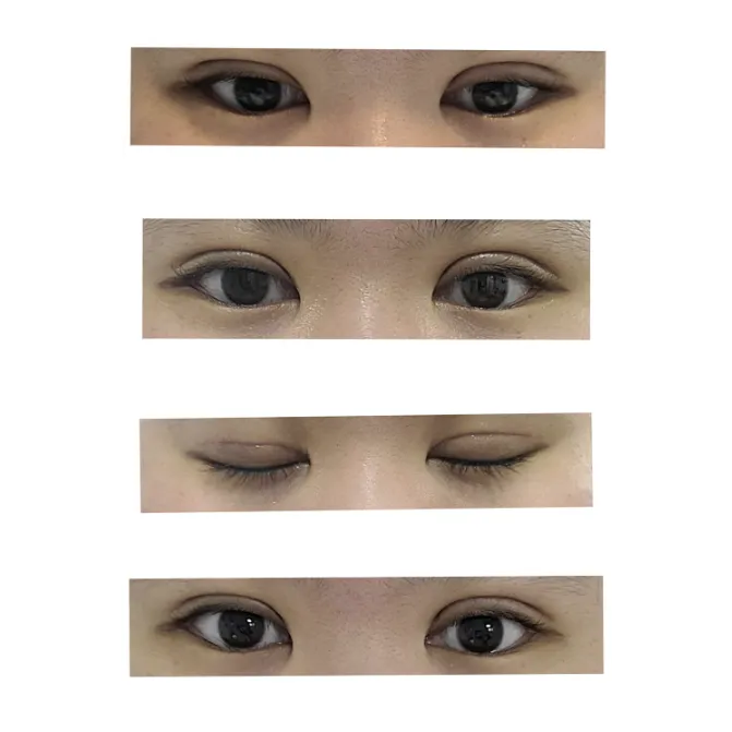 Revision ptosis correction — Afternoon Plastic Surgery 2