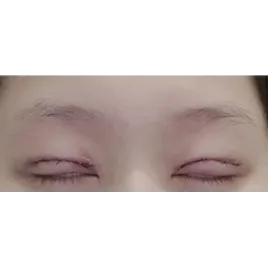 Incisional Double Eyelid Surgery, Revision ptosis correction — Afternoon Plastic Surgery 2