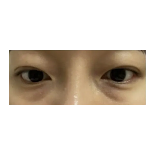 Lower Eyelid Fat Repositioning 1