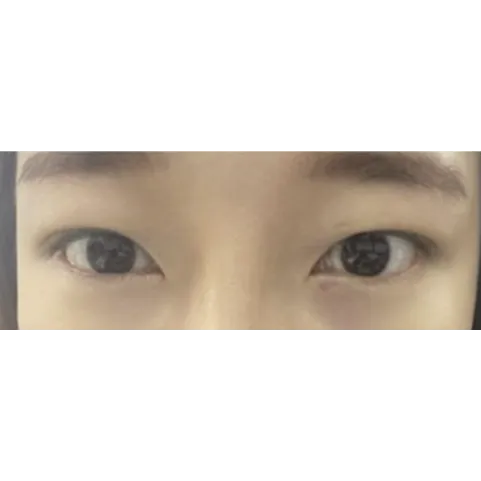 Lower Eyelid Fat Repositioning 2