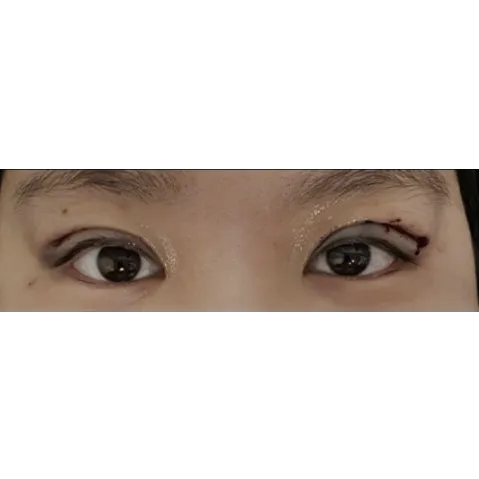Incisional Double Eyelid Surgery — Afternoon Plastic Surgery 2
