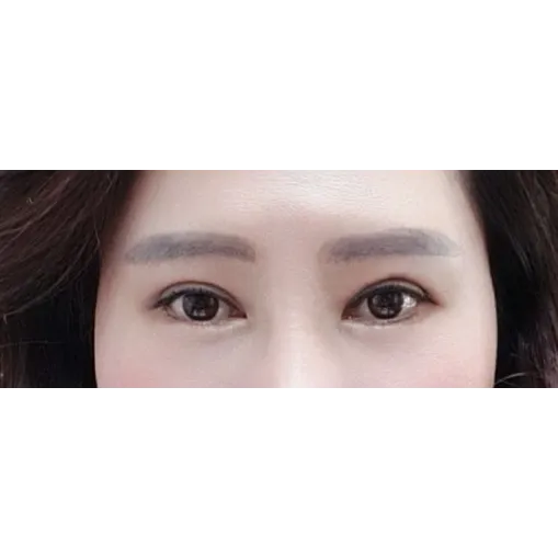 Incisional Double Eyelid Surgery — Afternoon Plastic Surgery 2