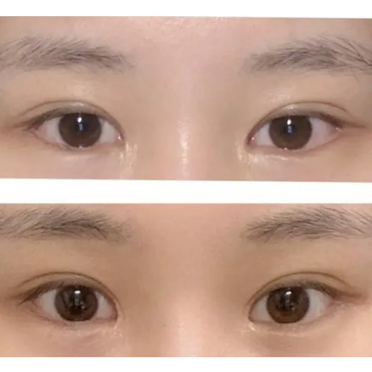 Epicanthoplasty Revision (Reconstruction) — Afternoon Plastic Surgery 1