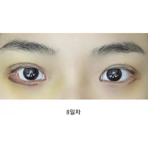 Revision ptosis correction — Afternoon Plastic Surgery 2
