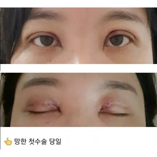 Revision ptosis correction — Afternoon Plastic Surgery 2