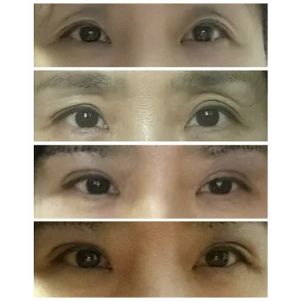 Revision ptosis correction 1