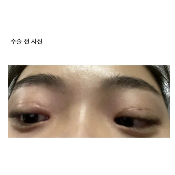 Revision ptosis correction, Puffy Eyelid Correction 1