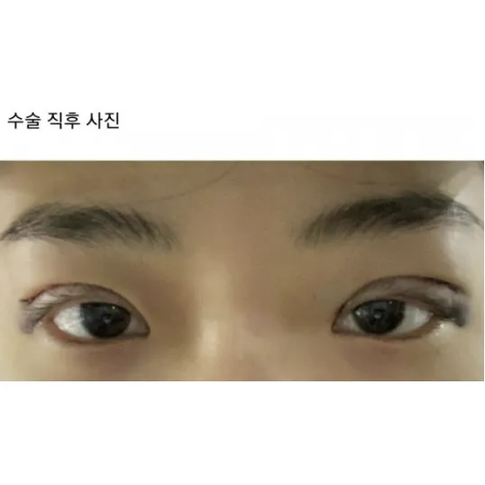 Revision ptosis correction, Puffy Eyelid Correction 2