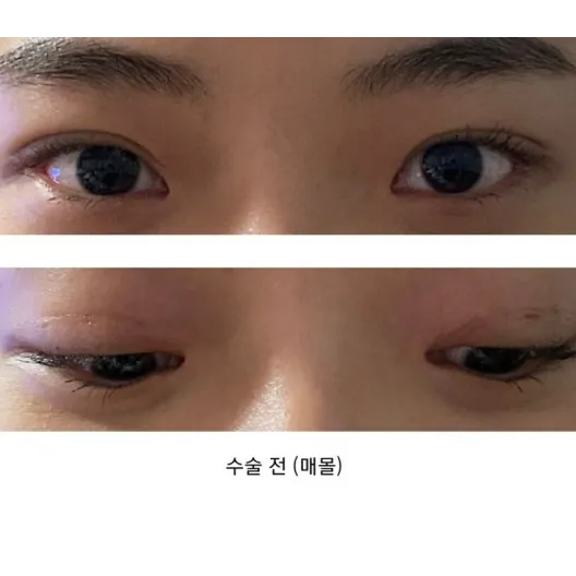 Incisional Double Eyelid Surgery — Afternoon Plastic Surgery 2