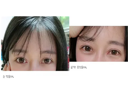 Incisional Double Eyelid Surgery 1