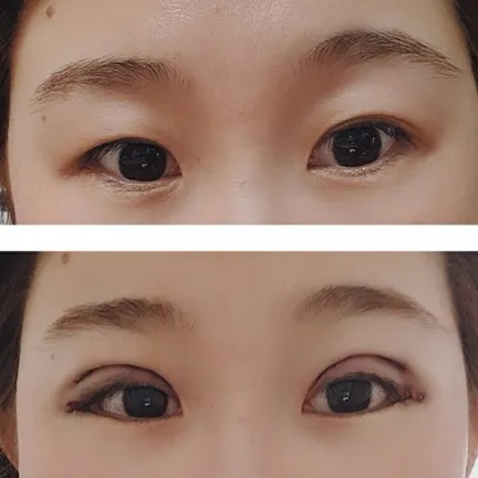Incisional Double Eyelid Surgery 1