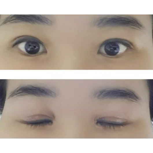 Revision ptosis correction, Incisional Double Eyelid Surgery — Afternoon Plastic Surgery 2
