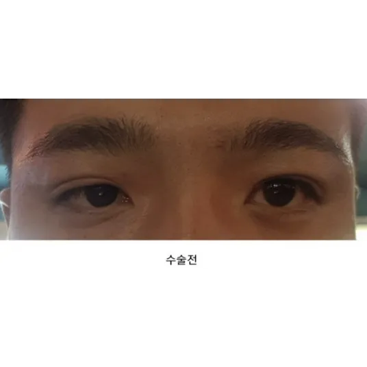 Incisional Double Eyelid Surgery, Ptosis Correction 1