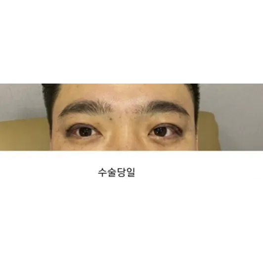 Incisional Double Eyelid Surgery, Ptosis Correction 2